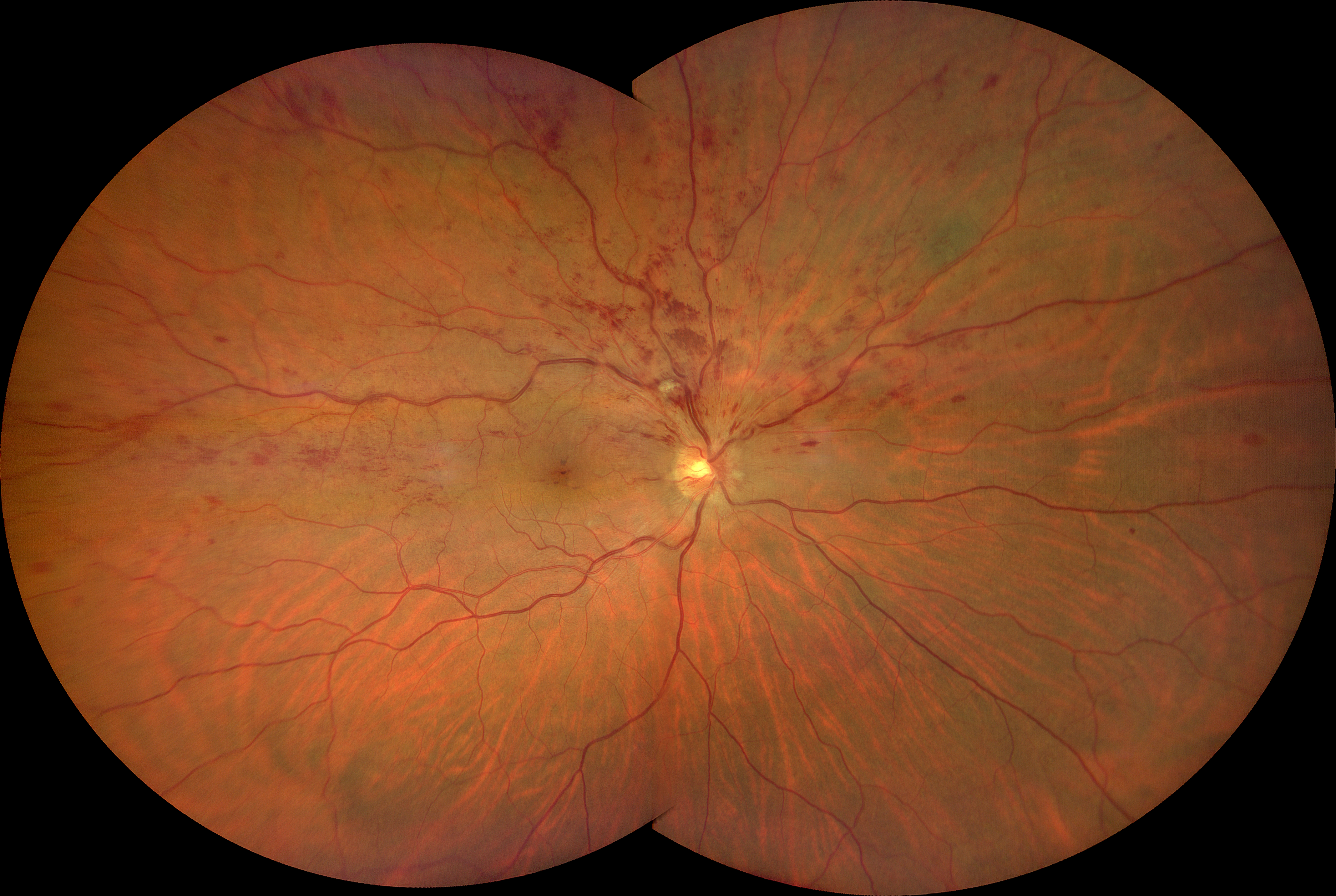 Occlusione retinica